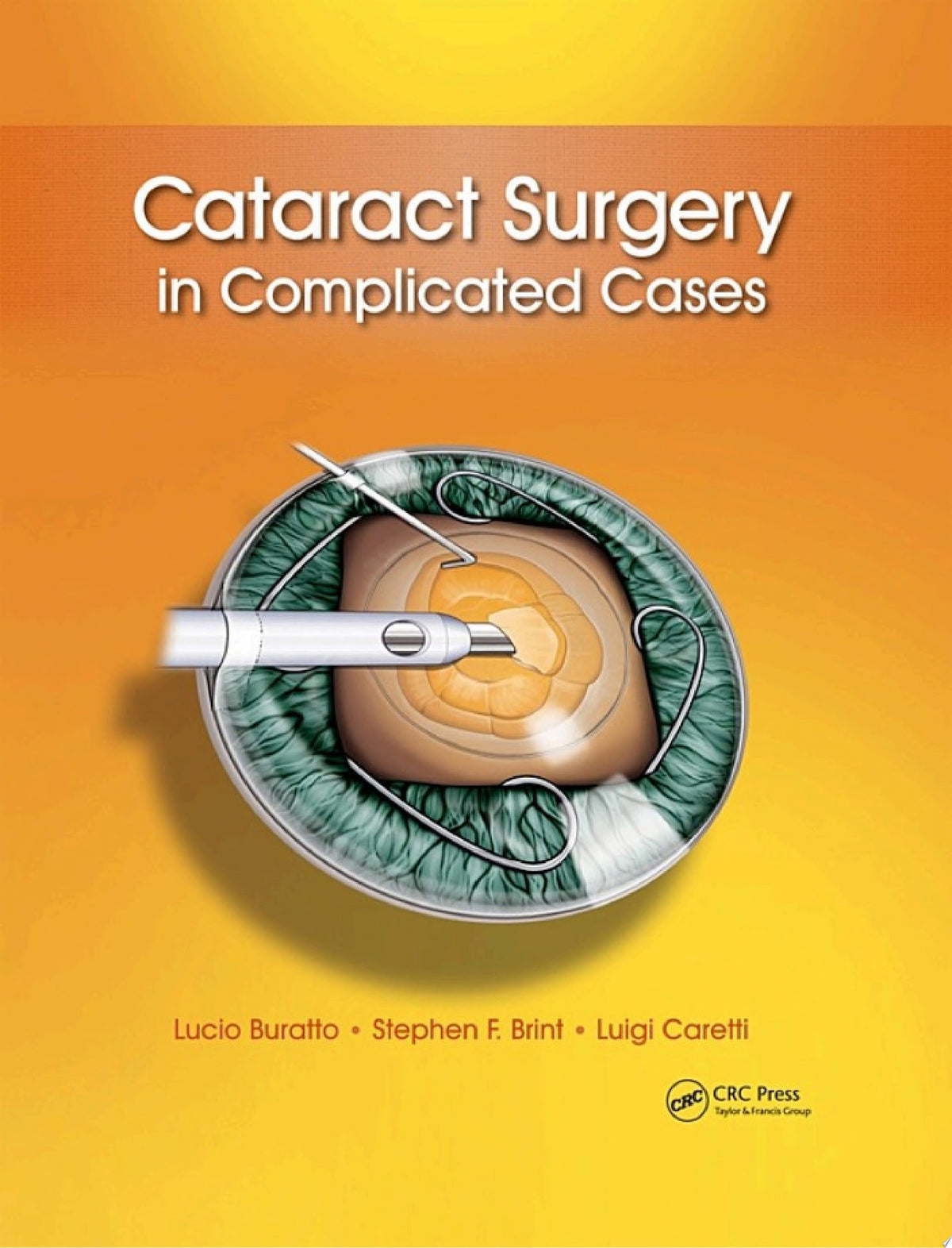 Cataract Surgery in Complicated Cases 1st Edition by Brint PDF