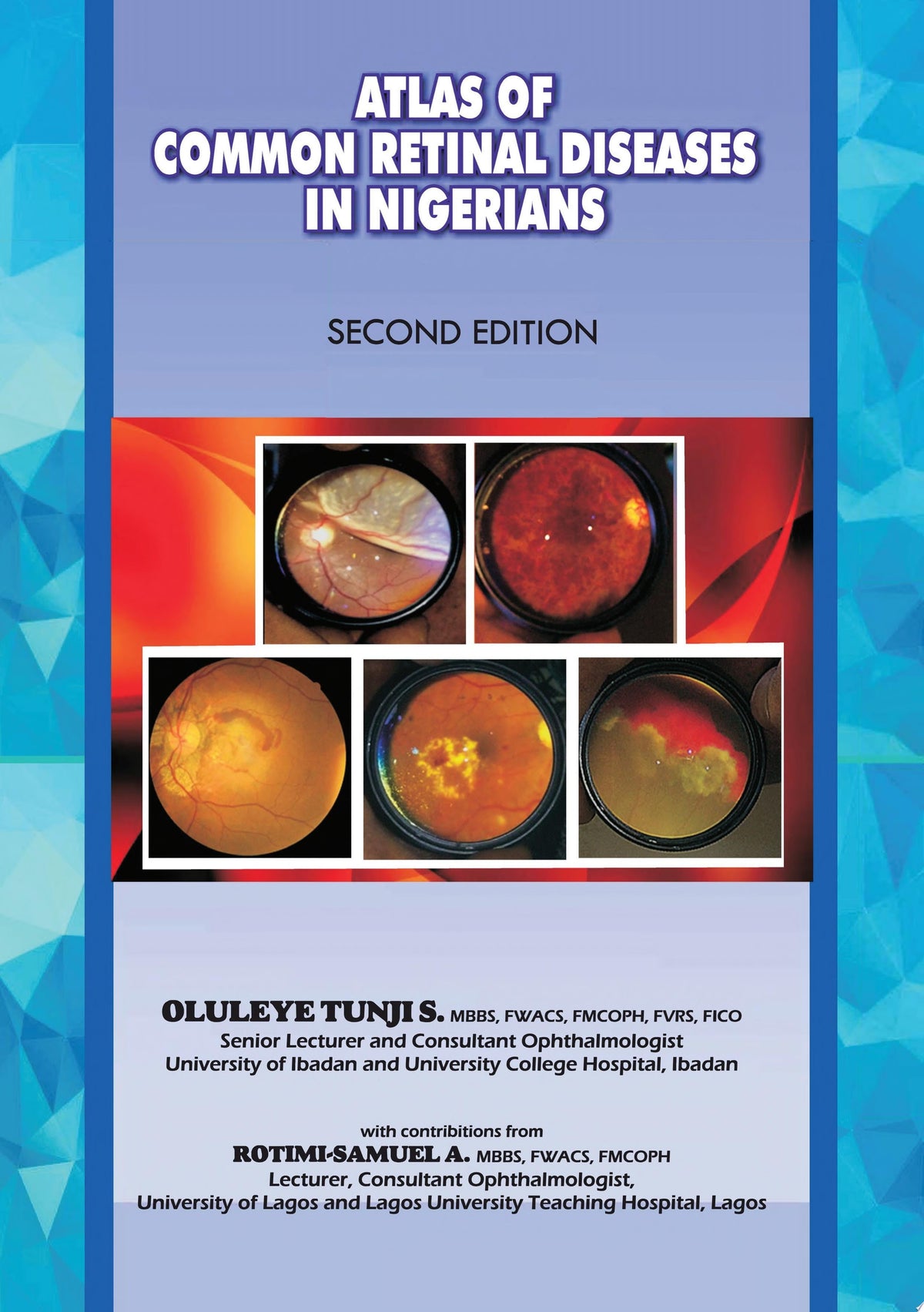 The Atlas of Retinal Diseases in Nigerians 1st Edition by Other Publisher PDF