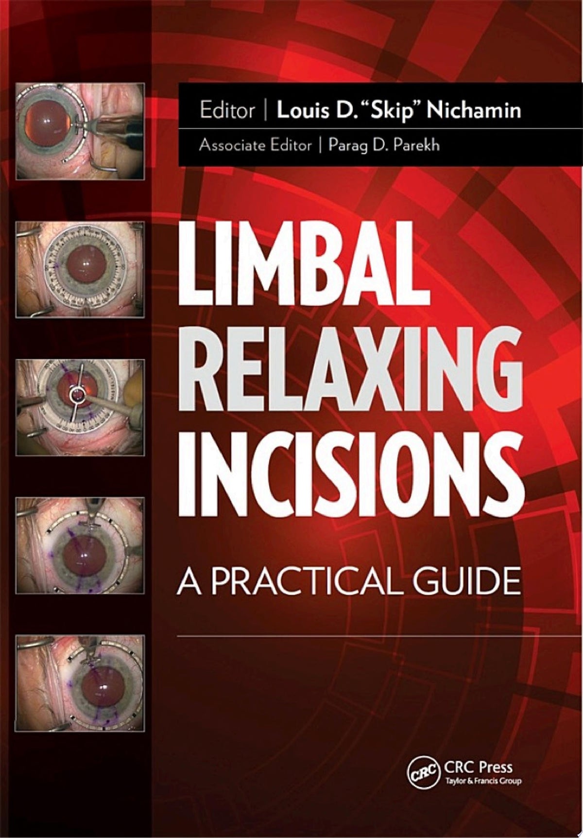 Limbal Relaxing Incisions: A Practical Guide 1st Edition by Slack Incorporated PDF