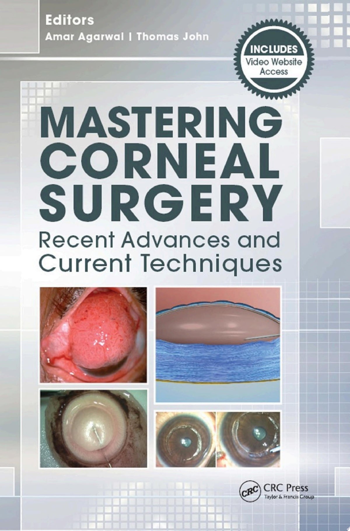 Mastering Corneal Surgery Recent Advances and Current Techniques 1st Edition by Agarwal & John PDF