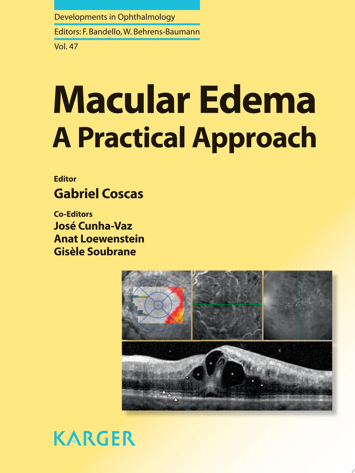 Macular Edema 1st Edition PDF