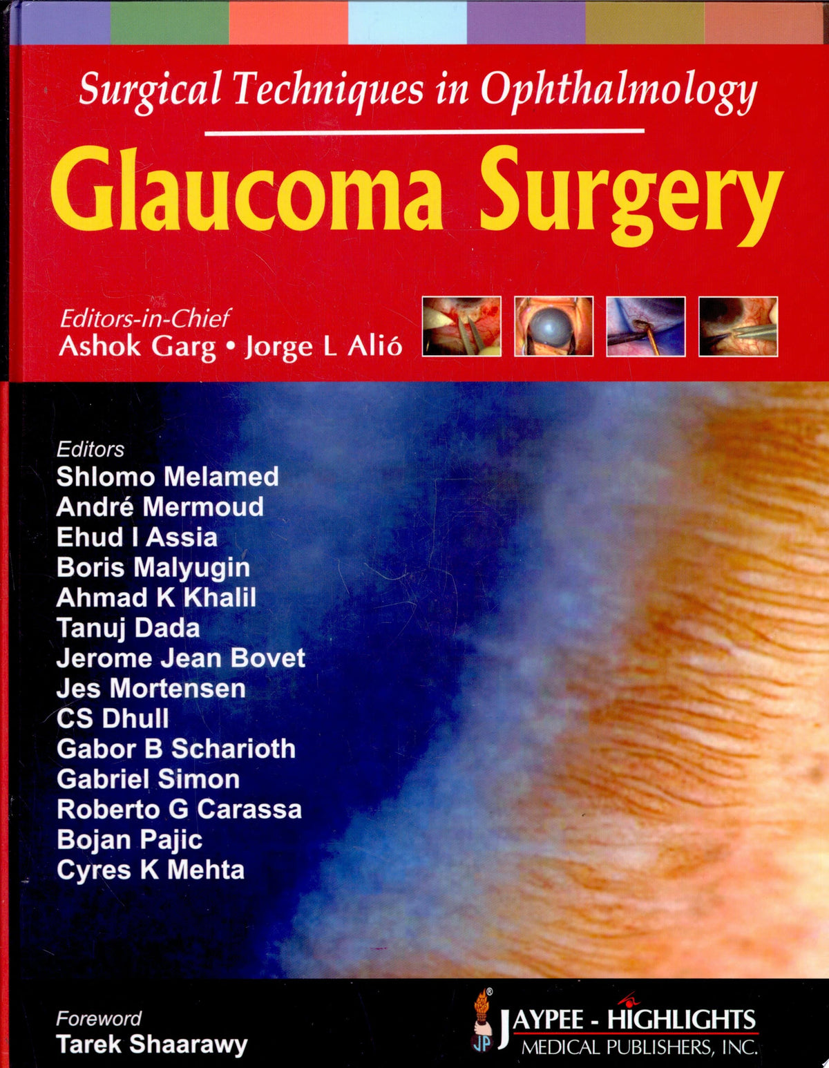 Glaucoma Surgery 1st Edition by Alio PDF