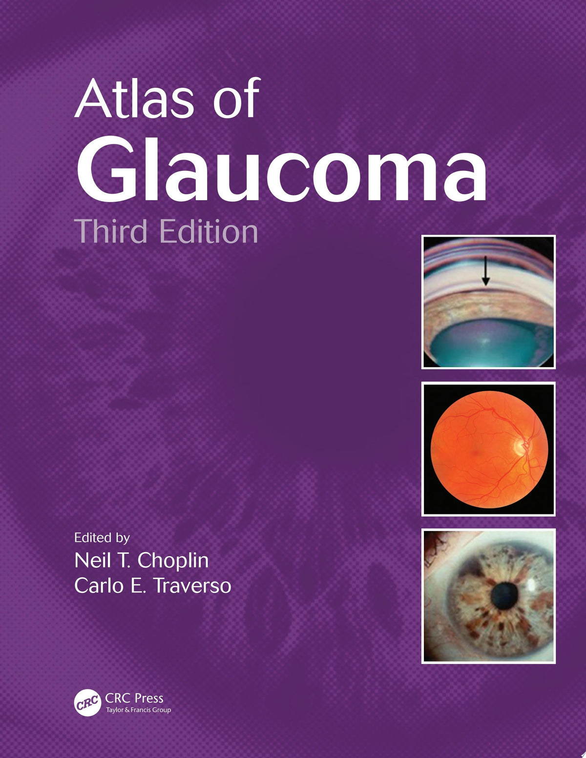 Atlas of Glaucoma 3rd Edition by Choplin PDF